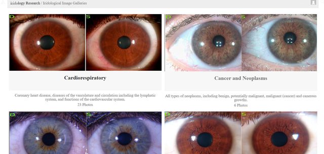 Case study galleries: paired right and left iris photographs grouped into categories such as Cardiorespiratory and Cancer and Neoplasms.