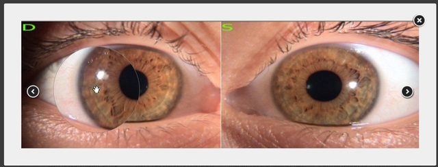 Zoom viewer showing a right and left iris side by side with a magnifier over the right iris.