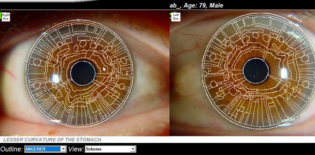 Right and left brown irises with an Angerer chart outline drawn over each and a zone named at the bottom.