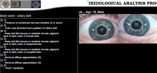 Checklist of signs for the brain zone of the ciliary belt beside thumbnails of both eyes.